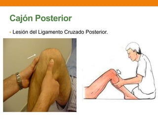 Cajón Posterior
• Lesión del Ligamento Cruzado Posterior.
 