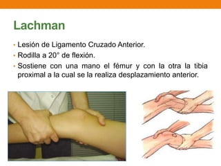 Lachman
• Lesión de Ligamento Cruzado Anterior.
• Rodilla a 20° de flexión.
• Sostiene con una mano el fémur y con la otra la tibia
proximal a la cual se la realiza desplazamiento anterior.
 