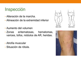 Inspección
• Alteración de la marcha.
• Alineación de la extremidad inferior
• Aumento del volumen
• Zonas eritematosas, hematomas,
varices, tofos, nódulos de AR, heridas.
• Atrofia muscular
• Situación de rótula.
 