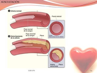 AUSCULTACIÓN




               ESM-IPN   114
 