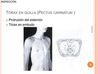INSPECCIÓN



   TÓRAX EN QUILLA (PECTUS CARINATUM )
    Protrusión del esternón
    Tórax en embudo




                                          ESM-IPN
                                         38
 