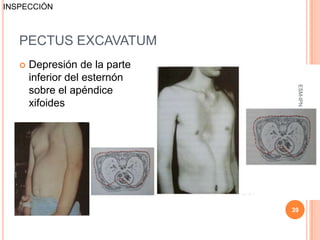 INSPECCIÓN



   PECTUS EXCAVATUM
      Depresión de la parte
       inferior del esternón




                                ESM-IPN
       sobre el apéndice
       xifoides




                               39
 
