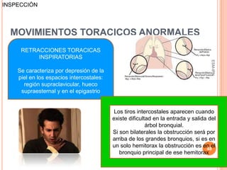 INSPECCIÓN




  MOVIMIENTOS TORACICOS ANORMALES
     RETRACCIONES TORACICAS
          INSPIRATORIAS




                                                                                    ESM-IPN
    Se caracteriza por depresión de la
    piel en los espacios intercostales:
      región supraclavicular, hueco
     supraesternal y en el epigastrio


                                           Los tiros intercostales aparecen cuando
                                          existe dificultad en la entrada y salida del
                                                         árbol bronquial.
                                          Si son bilaterales la obstrucción será por
                                          arriba de los grandes bronquios, si es en
                                          un solo hemitorax la obstrucción es en el
                                                                                  48
                                             bronquio principal de ese hemitorax
 