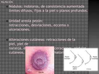 PALPACIÓN
    Nódulos:   indoloros, de consistencia aumentada
      límites difusos, fijos a la piel o planos profundos.

    Unidad   areola pezón:
      retracciones, desviaciones, eccema o
      ulceraciones.

    Alteraciones   cutáneas: retracciones de la
      piel, piel de
      naranja, eritema, edema, ulceraciones, nódulos
      cutáneos, alteraciones inflamatorias en general.




                         ESM-IPN               69
 