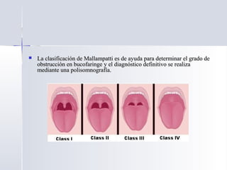  La clasificación de Mallampatti es de ayuda para determinar el grado deLa clasificación de Mallampatti es de ayuda para determinar el grado de
obstrucción en bucofaringe y el diagnóstico definitivo se realizaobstrucción en bucofaringe y el diagnóstico definitivo se realiza
mediante una polisomnografía.mediante una polisomnografía.
 