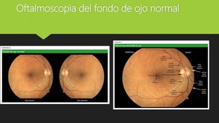 Oftalmoscopia del fondo de ojo normal
 