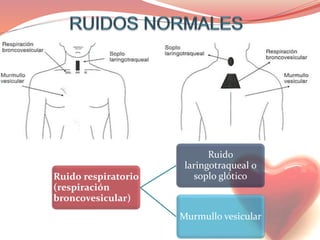 Ruido respiratorio
(respiración
broncovesicular)
Ruido
laringotraqueal o
soplo glótico
Murmullo vesicular
 