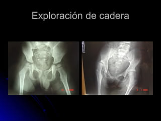 Exploración de cadera

 