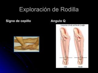 Exploración de Rodilla
Signo de cepillo

Angulo Q

 