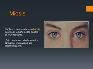 Miosis
Hablamos de un estado de Miosis
cuando el tamaño de las pupilas
es muy reducido.
Esto puede ser debido a ciertos
fármacos, intoxicación por
insecticidas. etc.
 