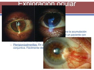    Sobre la superficie debe observarse…
    o Menisco lacrimal: Es el borde líquido que forma la acumulación
      lagrimal sobre el margen palpebral inferior. En un paciente con
      obstrucción lacrimal, esta línea del menisco lagrimal está más
      elevada, es más amplia, más gruesa.
    o Pterigion/palmerillas: Es un crecimiento benigno anormal de la
      conjuntiva. Fácilmente identificable.
 
