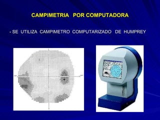 CAMPIMETRIA   POR COMPUTADORA - SE  UTILIZA  CAMPIMETRO  COMPUTARIZADO  DE  HUMPREY 
