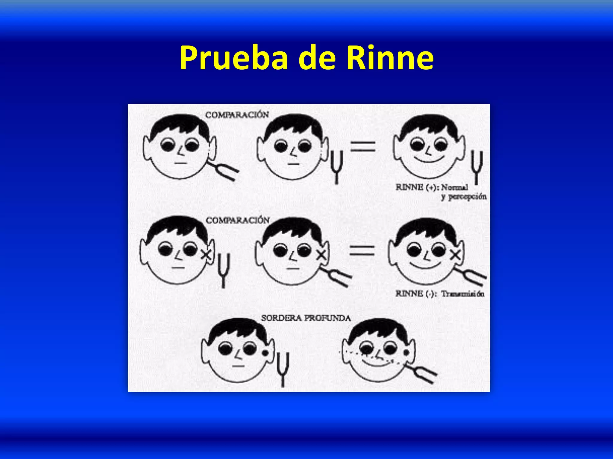 Prueba de Rinne