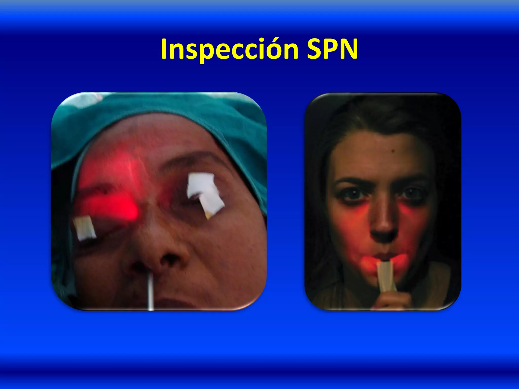 Inspección SPN