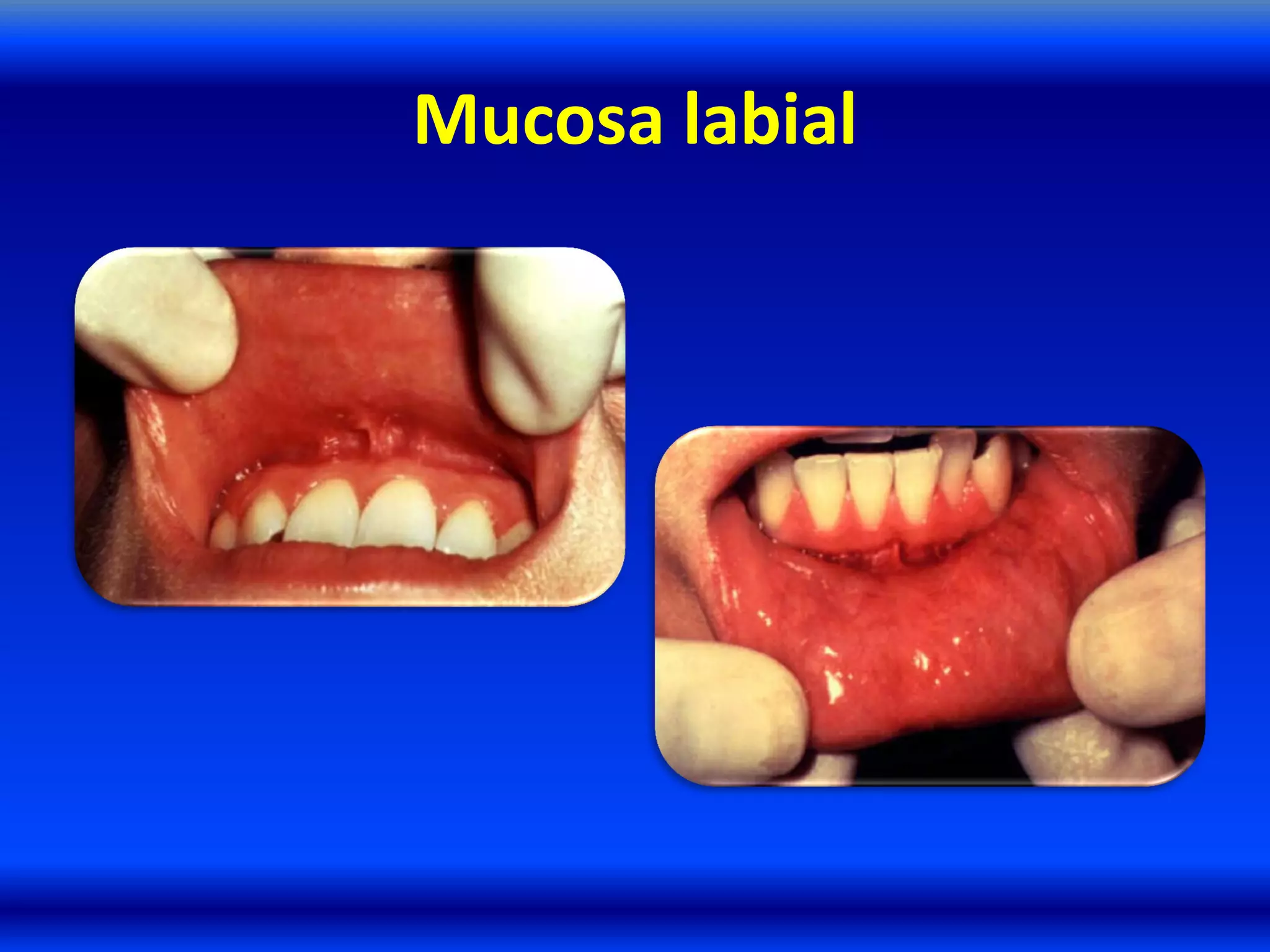 Mucosa labial