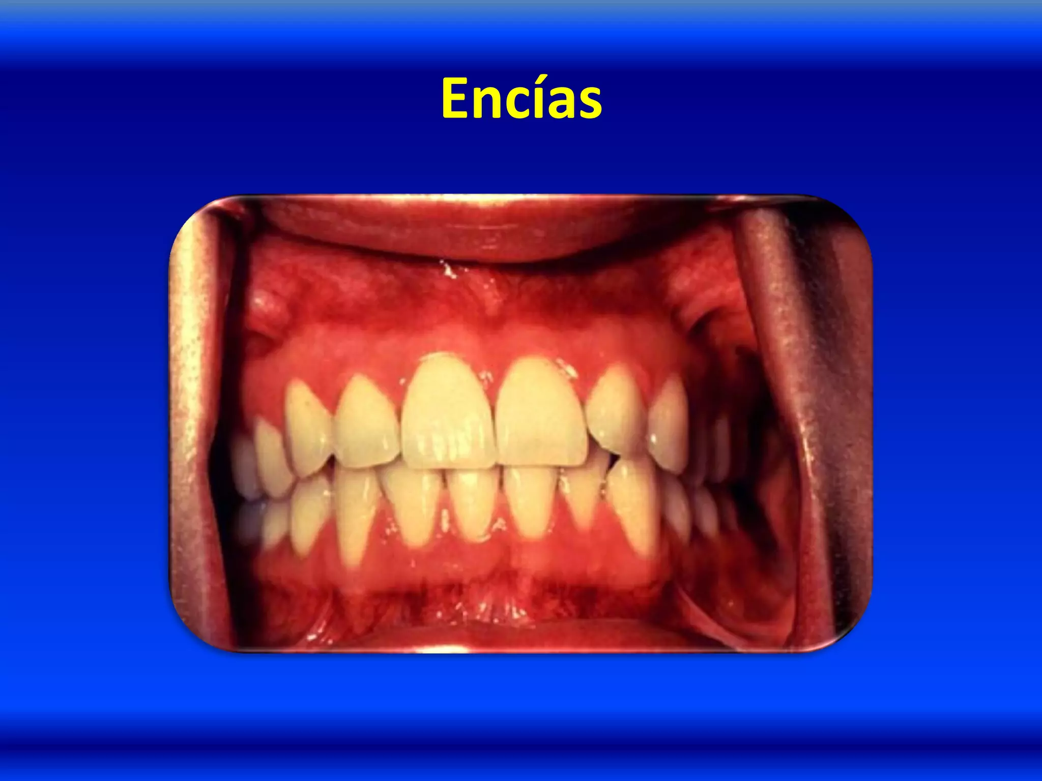 Encías