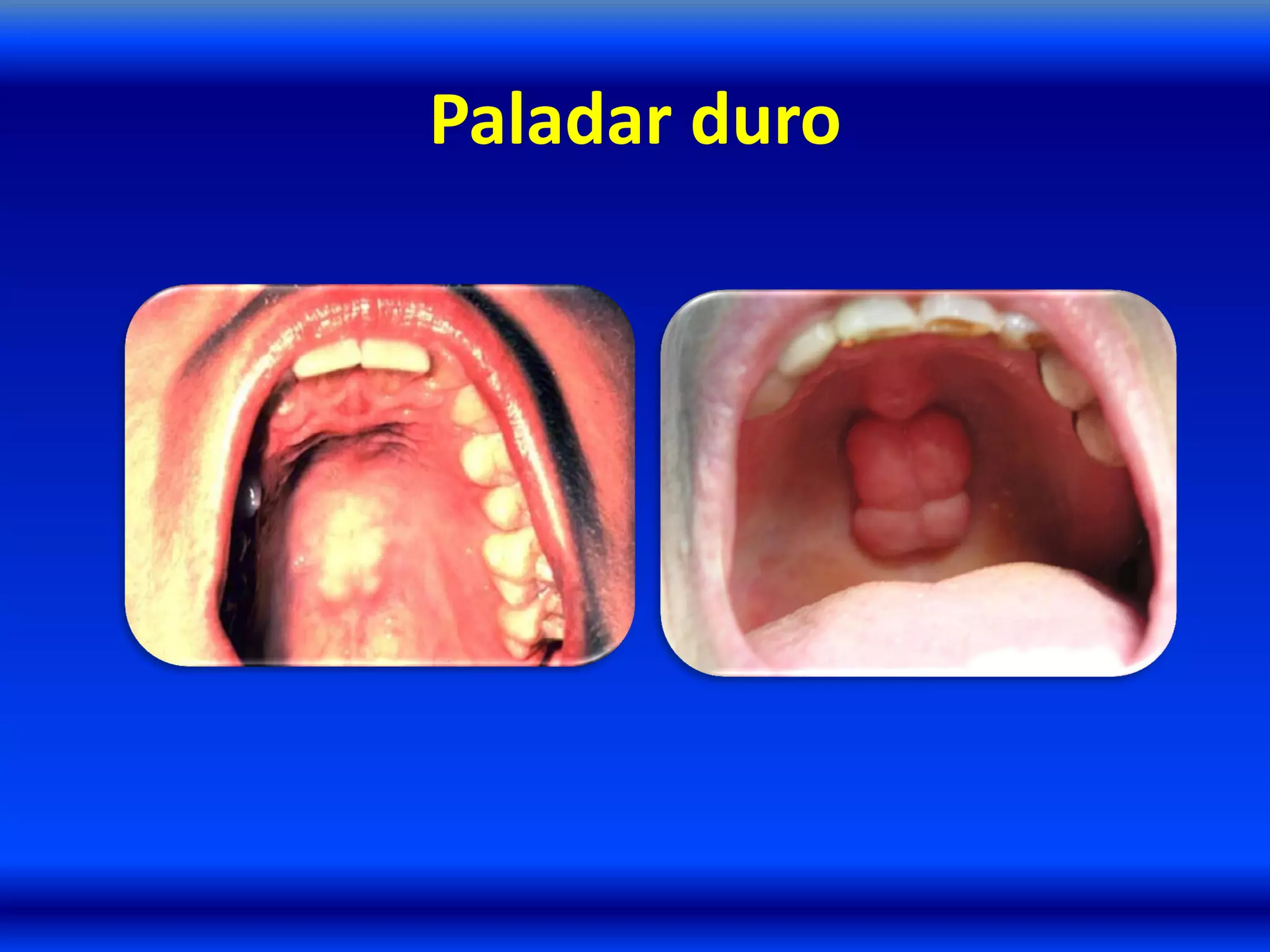 Paladar duro