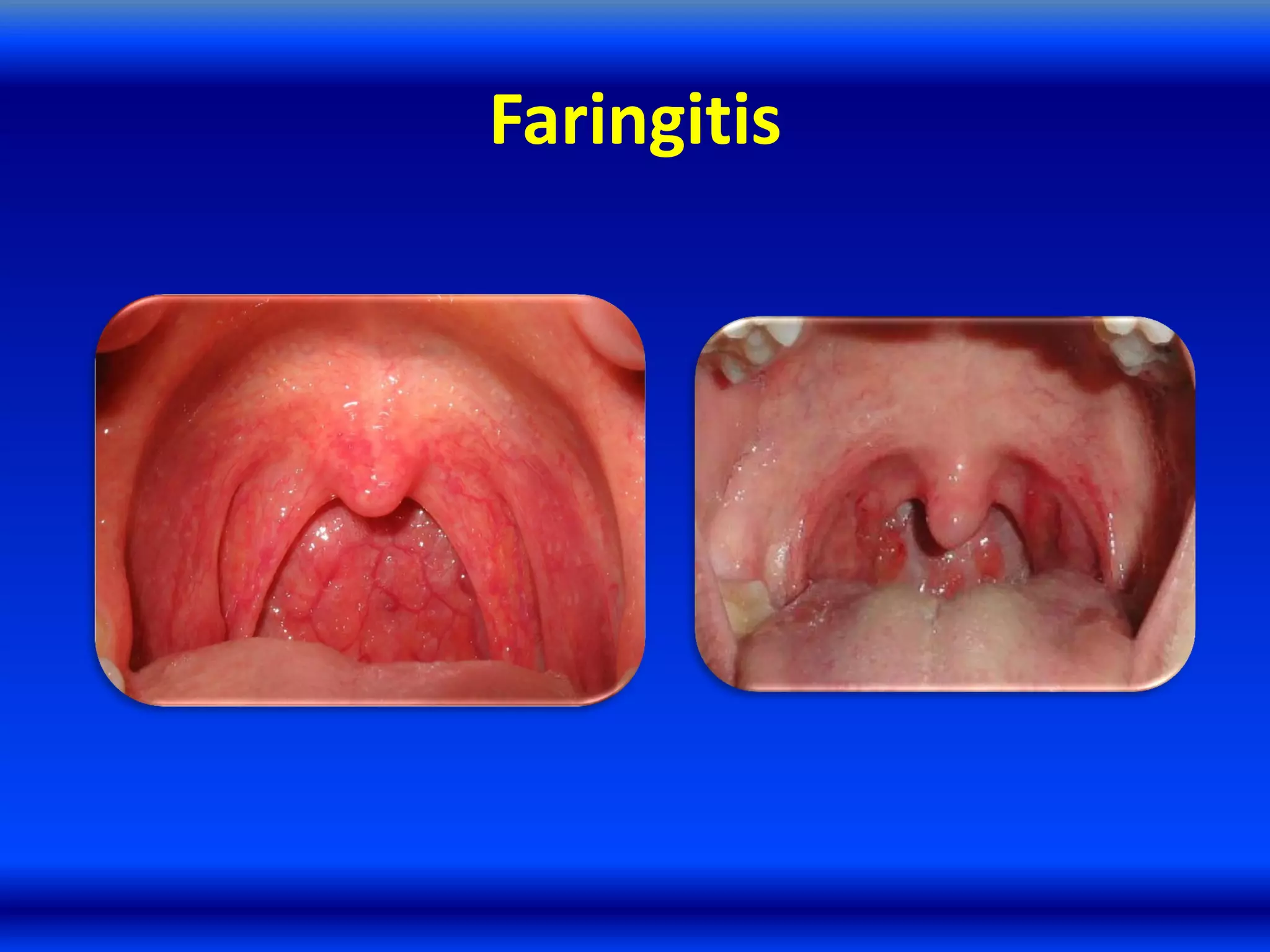 Faringitis