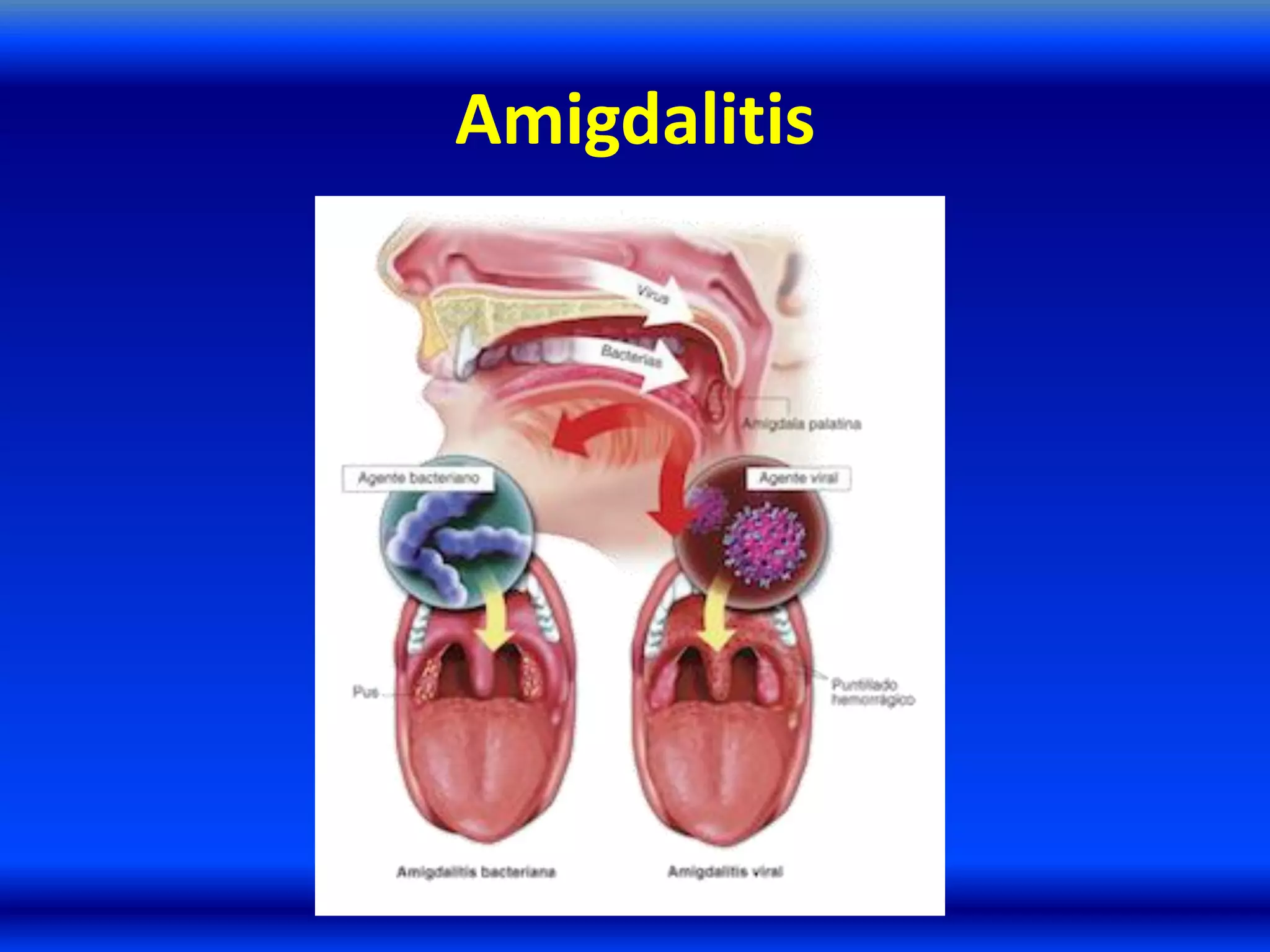Amigdalitis