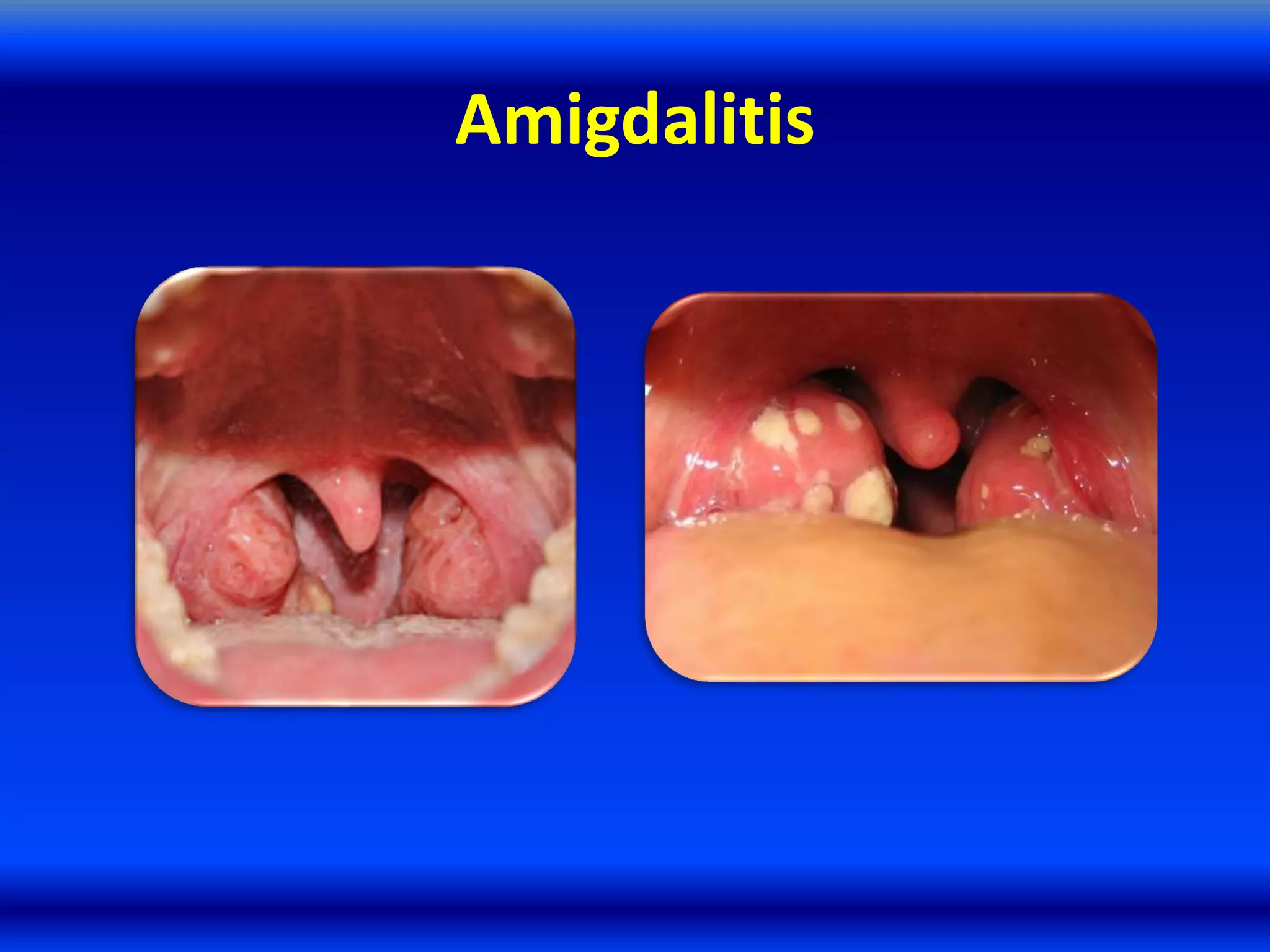 Amigdalitis