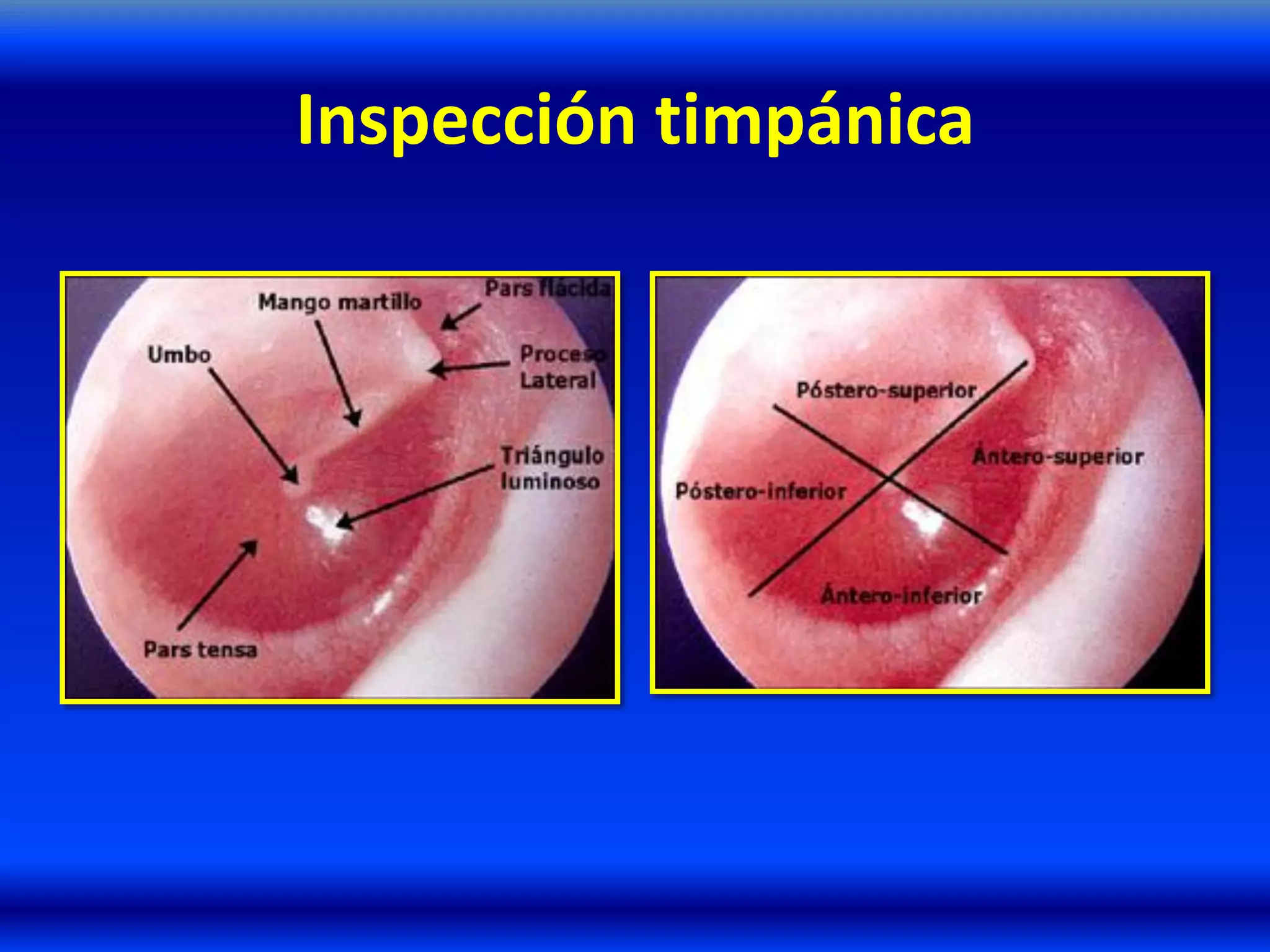 Inspección timpánica