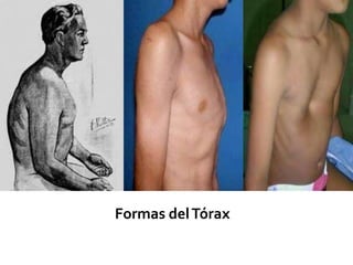 Formas del Tórax
 