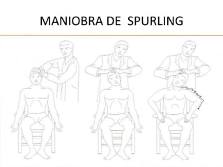 MANIOBRA DE SPURLING
 