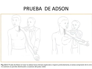 PRUEBA DE ADSON
 