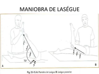MANIOBRA DE LASÉGUE
 