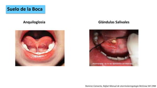 Ramirez Camacho, Rafael Manual de otorrinolaringología McGraw Hill 1998
Suelo de la Boca
Anquiloglosia Glándulas Salivales
 