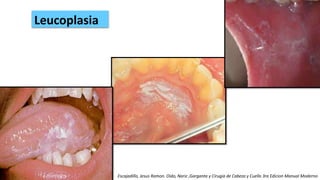 Leucoplasia
Escajadillo, Jesus Ramon. Oido, Nariz ,Garganta y Cirugia de Cabeza y Cuello 3ra Edicion Manual Moderno
 