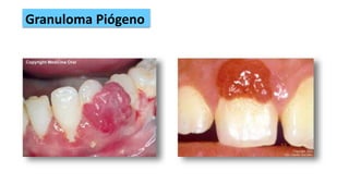 Granuloma Piógeno
 