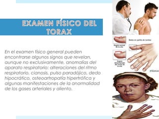 En el examen físico general pueden 
encontrarse algunos signos que revelan, 
aunque no exclusivamente, anomalías del 
aparato respiratorio: alteraciones del ritmo 
respiratorio, cianosis, pulso paradójico, dedo 
hipocrático, osteoartropatía hipertrófica y 
algunas manifestaciones de la anormalidad 
de los gases arteriales y aliento. 
 