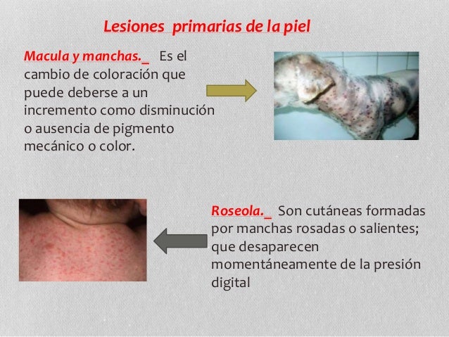 La mancha negra plana en la piel