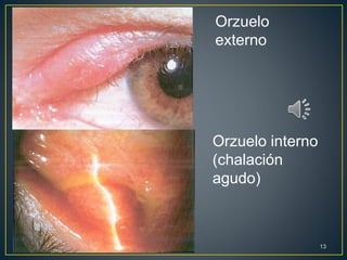 Orzuelo
externo
Orzuelo interno
(chalación
agudo)
13
 