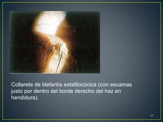 Collarete de blefaritis estafilocócica (con escamas
justo por dentro del borde derecho del haz en
hendidura).
17
 