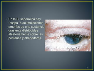 • En la B. seborreica hay
“caspa” o acumulaciones
amorfas de una sustancia
grasienta distribuidas
aleatoriamente sobre las
pestañas y alrededores.
18
 