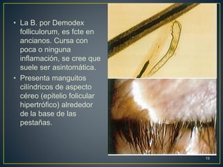 • La B. por Demodex
folliculorum, es fcte en
ancianos. Cursa con
poca o ninguna
inflamación, se cree que
suele ser asintomática.
• Presenta manguitos
cilíndricos de aspecto
céreo (epitelio folicular
hipertrófico) alrededor
de la base de las
pestañas.
19
 