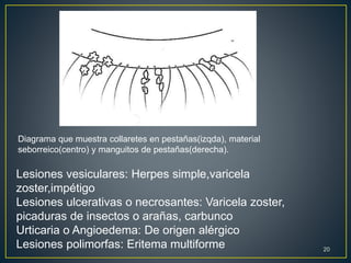 Diagrama que muestra collaretes en pestañas(izqda), material
seborreico(centro) y manguitos de pestañas(derecha).
Lesiones vesiculares: Herpes simple,varicela
zoster,impétigo
Lesiones ulcerativas o necrosantes: Varicela zoster,
picaduras de insectos o arañas, carbunco
Urticaria o Angioedema: De origen alérgico
Lesiones polimorfas: Eritema multiforme 20
 