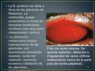 • La B. posterior se debe a
ttnos de las glándulas de
Meibomio. La
meibomitis, puede
presentarse en forma de
abscesos bacterianos,
nicóticos (rara vez),como
chalaziones(+ común).
• La disfunción
meibomiana implica
hipersecreción de las
glándulas, con
secreciones demasiado
espesas, cursa con
repleción, secreción
excesiva o dilatación de
las glándulas, 21
Pcte con acné rosacea. Se
aprecia repleción, dilatación e
irregularidad de varios orificios
meibomianos (cerca de la parte
post del borde palpebral).
 