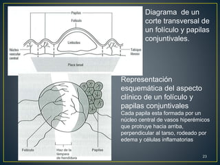 Diagrama de un
corte transversal de
un folículo y papilas
conjuntivales.
Representación
esquemática del aspecto
clínico de un folículo y
papilas conjuntivales
Cada papila esta formada por un
núcleo central de vasos hiperémicos
que protruye hacia arriba,
perpendicular al tarso, rodeado por
edema y células inflamatorias
23
 