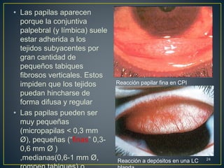 • Las papilas aparecen
porque la conjuntiva
palpebral (y límbica) suele
estar adherida a los
tejidos subyacentes por
gran cantidad de
pequeños tabiques
fibrosos verticales. Estos
impiden que los tejidos
puedan hincharse de
forma difusa y regular
• Las papilas pueden ser
muy pequeñas
(micropapilas < 0,3 mm
Ø), pequeñas (“finas” 0,3-
0,6 mm Ø )
,medianas(0,6-1 mm Ø, 24
Reacción papilar fina en CPI
Reacción a depósitos en una LC
 