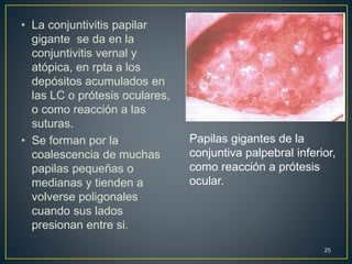 • La conjuntivitis papilar
gigante se da en la
conjuntivitis vernal y
atópica, en rpta a los
depósitos acumulados en
las LC o prótesis oculares,
o como reacción a las
suturas.
• Se forman por la
coalescencia de muchas
papilas pequeñas o
medianas y tienden a
volverse poligonales
cuando sus lados
presionan entre si.
25
Papilas gigantes de la
conjuntiva palpebral inferior,
como reacción a prótesis
ocular.
 