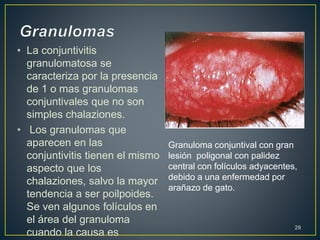 • La conjuntivitis
granulomatosa se
caracteriza por la presencia
de 1 o mas granulomas
conjuntivales que no son
simples chalaziones.
• Los granulomas que
aparecen en las
conjuntivitis tienen el mismo
aspecto que los
chalaziones, salvo la mayor
tendencia a ser poilpoides.
Se ven algunos folículos en
el área del granuloma
cuando la causa es
29
Granuloma conjuntival con gran
lesión poligonal con palidez
central con folículos adyacentes,
debido a una enfermedad por
arañazo de gato.
 