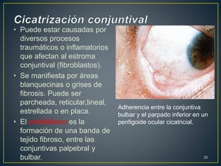 • Puede estar causadas por
diversos procesos
traumáticos o inflamatorios
que afectan al estroma
conjuntival (fibroblastos).
• Se manifiesta por áreas
blanquecinas o grises de
fibrosis. Puede ser
parcheada, reticular,lineal,
estrellada o en placa.
• El simbléfaron es la
formación de una banda de
tejido fibroso, entre las
conjuntivas palpebral y
bulbar. 32
Adherencia entre la conjuntiva
bulbar y el parpado inferior en un
penfigoide ocular cicatricial.
 