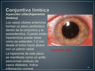 Inyección ciliar(hiperemia
límbica)
Los vasos ciliares anteriores
forman un plexo perilimbico
dentro de la conjuntiva y la
epiesclerotica. Cuando están
hiperémicos puede verse
como se extienden 1-2 mm
desde el limbo hacia afuera
con un patrón radial.
La hiperemia de este plexo
se manifiesta como un anillo
pericorneal violáceo de
vasos dilatados. Indica
inflamación corneal,
35
Inyección ciliar
 
