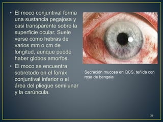 • El moco conjuntival forma
una sustancia pegajosa y
casi transparente sobre la
superficie ocular. Suele
verse como hebras de
varios mm o cm de
longitud, aunque puede
haber globos amorfos.
• El moco se encuentra
sobretodo en el fornix
conjuntival inferior o el
área del pliegue semilunar
y la carúncula.
39
Secreción mucosa en QCS, teñida con
rosa de bengala
 