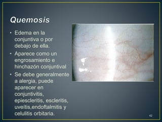 • Edema en la
conjuntiva o por
debajo de ella.
• Aparece como un
engrosamiento e
hinchazón conjuntival
• Se debe generalmente
a alergia, puede
aparecer en
conjuntivitis,
epiescleritis, escleritis,
uveítis,endoftalmitis y
celulitis orbitaria. 42
 