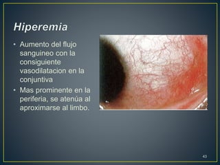 • Aumento del flujo
sanguineo con la
consiguiente
vasodilatacion en la
conjuntiva
• Mas prominente en la
periferia, se atenúa al
aproximarse al limbo.
43
 
