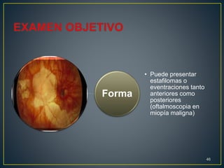 Forma
• Puede presentar
estafilomas o
eventraciones tanto
anteriores como
posteriores
(oftalmoscopia en
miopía maligna)
46
 
